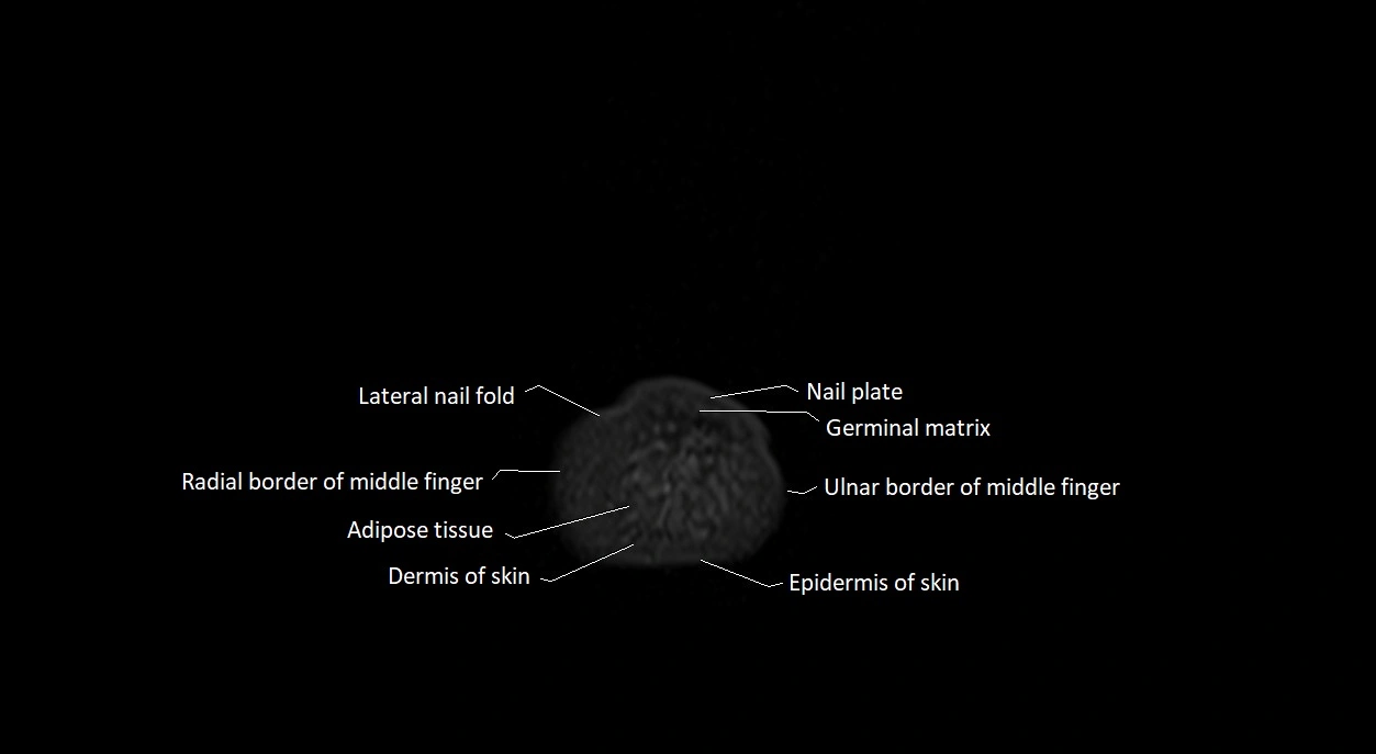 Finger anatomy axial cross sectional 3T image image 1.webp